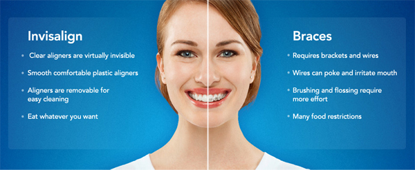Invisalign clear aligners